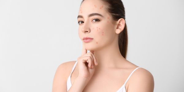 Blemish Treatment Solutions: Unlock the Power of Acne Solution and Spot Treatments