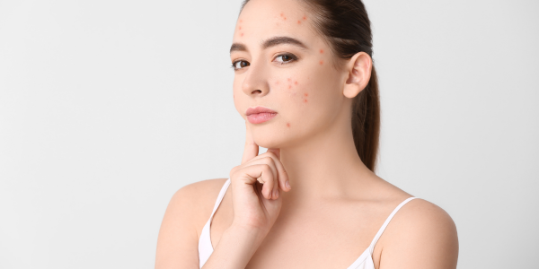 Clean Beauty Solutions for Acne: The Ultimate Guide